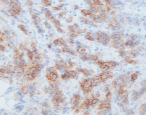 MicroStacker Enhanced detection - HER2 IHC