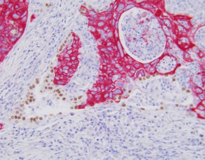 CK5/6/TTF-1 detection reagent (Immunohistochemical)