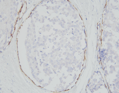 CK5/6/p63 detection reagent (Immunohistochemical)