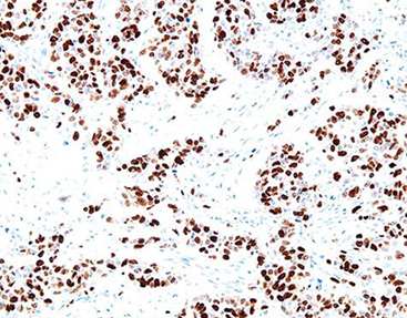 What Causes Primary Antibody Deficiency Symptoms and Treatment Guide