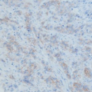 REAL EnVision detection - HER2 IHC