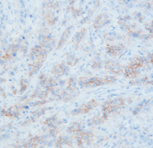 MicroStacker Universal detection - HER2 IHC